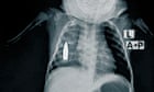 X-rays show shrapnel and bullets buried in children caught in Sudan war