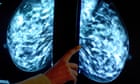 More breast cancer cases found when AI used in screenings, study finds